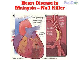 Cardiovascular disease includes diseases of the heart, veins and arteries. Heart Disease In Malaysia No 1 Killer Malaysia Health Family Medicine And Healthcare