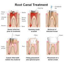 It vanishes after a week, but if it recurs infection may spread. Dental Crown After Root Canal Therapy Flowood Ms
