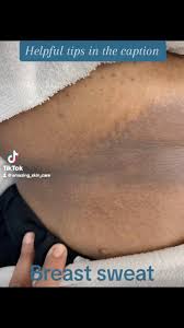 Image result for Intertrigo under breasts