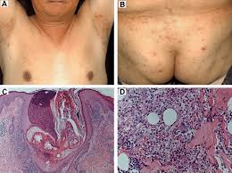 Image result for Pustule