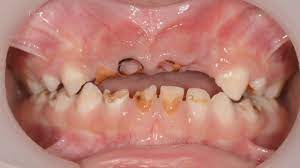 We did not find results for: Children S Rotting Teeth Costs Nhs 35m A Year Youtube