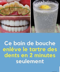 Methode Naturelle Pour Avoir Des Dents Propres Et Blanches Sante Nutrition En 2020 Detartrage Dents Detartrer Dents Blanchir Les Dents Naturellement