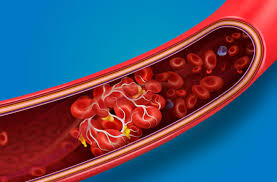 We did not find results for: Should You Be Worried About Blood Clots With Covid 19 Health Essentials From Cleveland Clinic