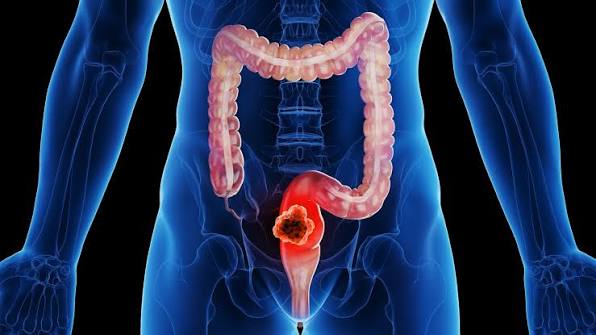 A Rectal Cancer Immunotherapy That Lets Some Patients Skip Chemo, Radiation, and Surgery