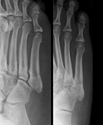 Sir robert jones was the first to consult your surgeon: The Fracture Heard Down Broad Street Pr News
