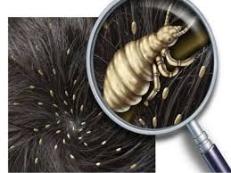 Image result for pediculosis