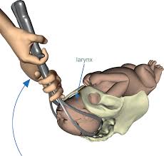 Image result for Forceps Assisted Delivery