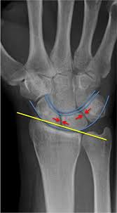 Image result for Wrist XRay