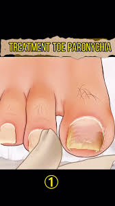Image result for Paronychia feet