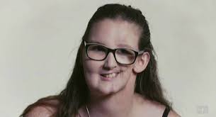 People with facial disfigurement share experience of prejudice