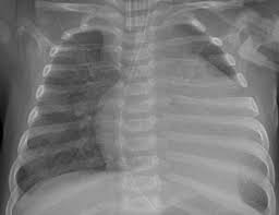 Durch die katheteruntersuchung können gefäße und herzkammern dargestellt und somit eine diagnose. Mykke Myokarditis Register Bis Zum 18 Lebensjahr
