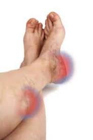 Blood Clot Beaver Valley Foot Clinic