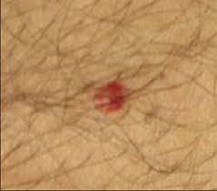 Angiomas have lacunae on dermoscopy. Skin Disorders In Older Adults Vascular Lymphatic And Purpuric Dermatitides Part 1