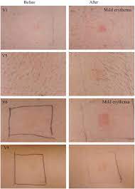 Evaluation Of The Clinical Impact Of Repeat Application Of Hydrogel Forming Microneedle Array Patches Springerlink