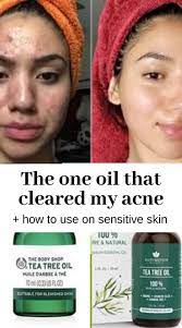 How To Use Tea Tree Oil To Cure Acne In Sensitive Skin Acne Tea Tree Oil For Acne Clear Face Tips Tea Tree Oil Uses