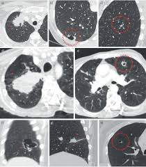 Pancreatic cancer may also be misdiagnosed as gallstones or pancreatitis, or the inflammation of the pancreas. Cyst Related Primary Lung Malignancies An Important And Relatively Unknown Imaging Appearance Of Early Lung Cancer European Respiratory Society