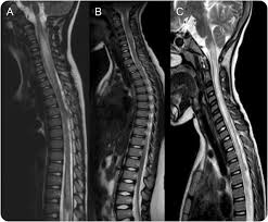 Generally, inflammation at one segment causes symptoms at that level and below that level. Pediatric Transverse Myelitis Neurology