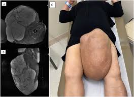 Image result for Liposarcoma
