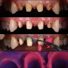 Only For Dentists After Removal Of The Existing Crowns Tooth Preparation Was Refined Double Cord 000 1 Was Placed And Second Cord 1 Was Removed Before