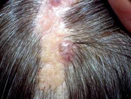Timing and rationale of excision are based on the science behind the nevus sebaceous. Sebaceous Naevus Dermnet Nz
