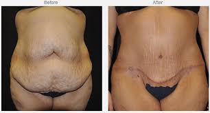 You get a smaller stomach pouch, which attaches lower down your small intestine. Post Massive Weight Loss Surgery In Dallas Tx Skin Tightening Plano Tx