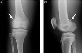 Maybe you would like to learn more about one of these? A Rare Knee Fracture With Underestimated Severity The Western Journal Of Emergency Medicine