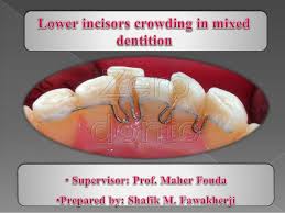 「" 	 crowding」的圖片搜尋結果