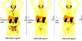 19.04.2021 · in the meantime, our priority as a charity is to fund research to improve treatments for prostate cancer, curing more men and causing less harm in the process.' Early Treatment Of Advanced Prostate Cancer With Radioligand Therapy Prolongs Life