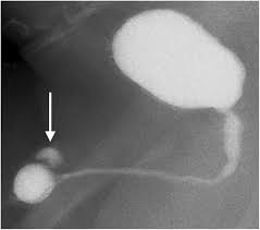 Image result for Voiding Cystourethrogram