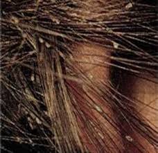 Pin On Liceworx Natural Head Lice Products