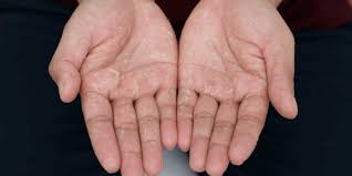 Image result for dyshidrosis