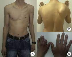 To view before and after photos of poland syndrome patients , please click on each thumbnail to enlarge to full size. Clinical Analysis Of 113 Patients With Poland Syndrome Sciencedirect