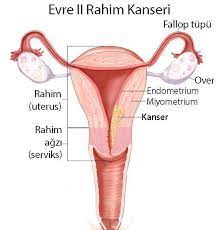 Son evre olarak tanımlanabilecek bu evrede kanser üst karın bölgesi, lenf bezleri, kemikler ve rahme uzak olan organlara ulaşmış olur. Rahim Kanseri Belirtileri Evreleri Tani Ve Tedavisi