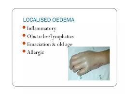 Image result for Localized Edema