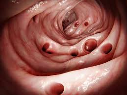 Image result for Diverticulitis