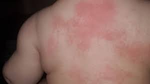 Symptoms can include fever, rash, eye irritation, swollen hands or feet and belly pain. Infant Diagnosed With Covid 19 Parents Tipped Off By Rash