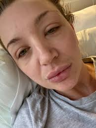 Mum, 35, forced to have all four limbs amputated warns of deadly sepsis  dangers