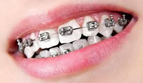 How long will it take for braces to straighten your teeth? Pin On Fashion Funda