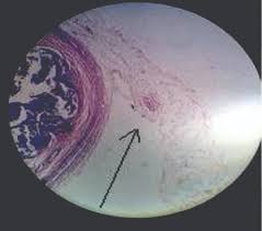 Sign in | create account. Jcdr Appendices Epiploicae Lymphoid Infiltration Mesentery Torsion