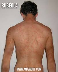 Rubeola Sintomas Diagnostico E Tratamento Md Saude