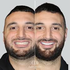 Before and after veneer treatment. After image taken 2 weeks  post-treatment. Please note results shown are specific to this patient and  will vary for each individual. All images and videos