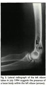 Image result for Ballottable Patella Sign