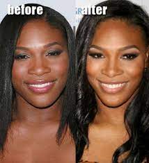 Celebrity Plastic Surgery Before After 56 Pics Celebrity Plastic Surgery Plastic Surgery Cosmetic Surgery