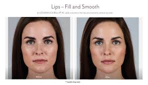 Every practitioner has different philosophies, techniques, and levels of experience. Juvederm Before And After Pictures Juvederm Westport Ct