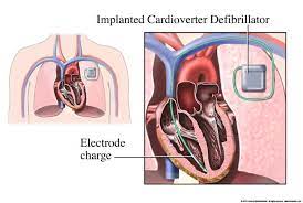 Christian eriksen (29) von dänemark spielt den ball. Read E Book Implantable Cardioverter Defibrillator Icd