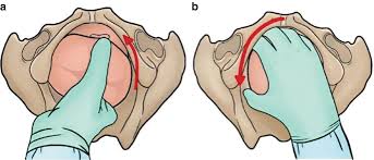 Image result for Manual Rotation in Occipitoposterior Presentation