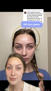 PRP Under Eye Treatment: 6-Month Update