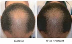 Use a hydrating serum such as hyaluronic acid before microneedling to lubricate the skin, helping. Microneedling For Hair Loss What S The Best Needle Length It Depends