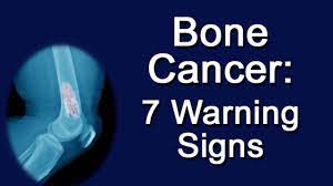 They may arise from the bone tissue, and we call them primary bone tumors. Bone Cancer 7 Warning Signs Youtube