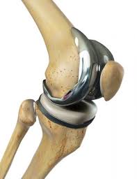 Der äußere teil des oberschenkels ist stärker als der innere, und die hüftbeugemuskulatur ist schwach. Knieendoprothese Knie Tep Kunstliches Kniegelenk Bei Kniearthrose Gelenk Klinik De